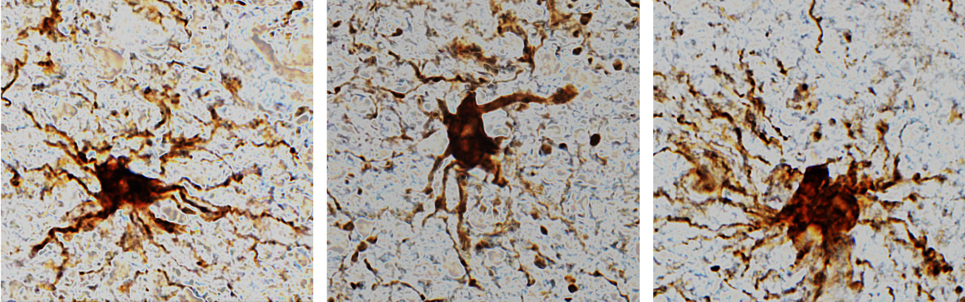 Zombie brain genes have been identified in donated brain tissues after studies.