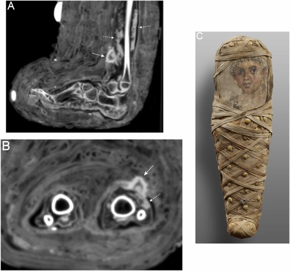 The finding of the Egyptian mummy of an infant brought a curious discovery.