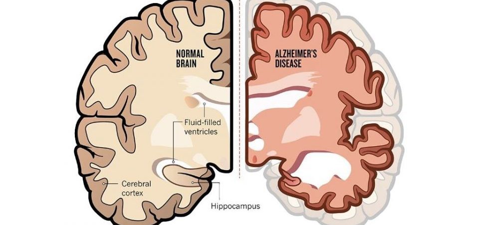 Alzheimer's is a disease that causes profound brain damage.